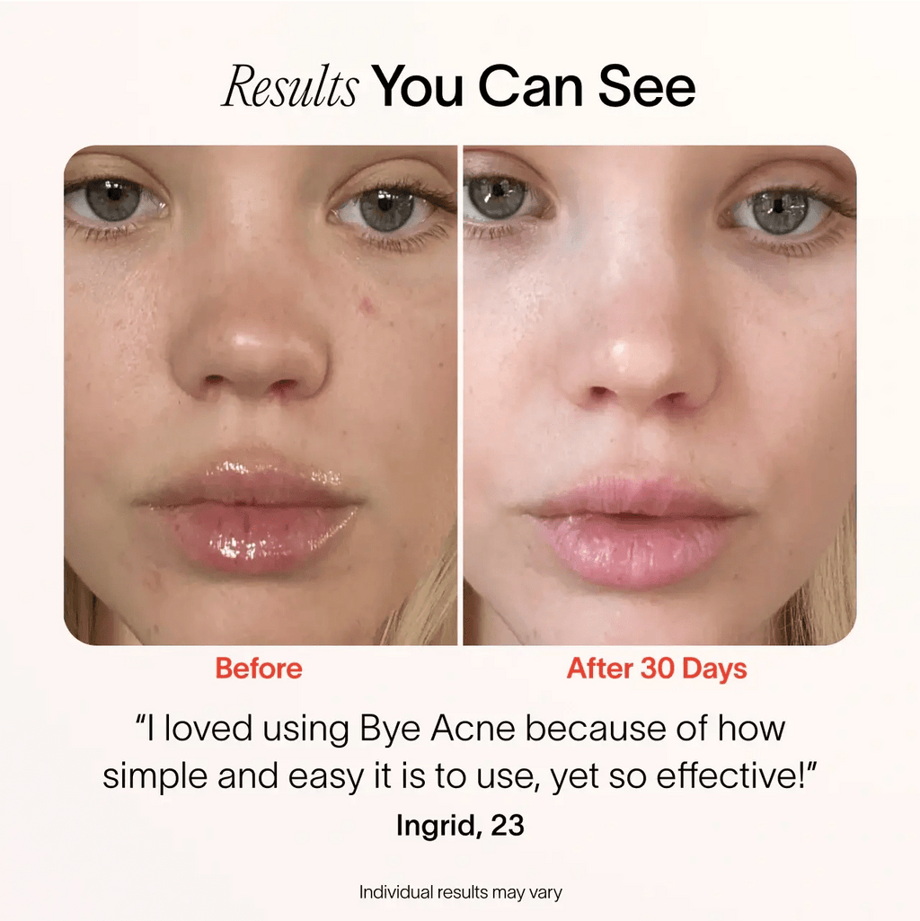 Bye Acne: 3 - Minute Pimple Spot Treatment - Mac's Got More