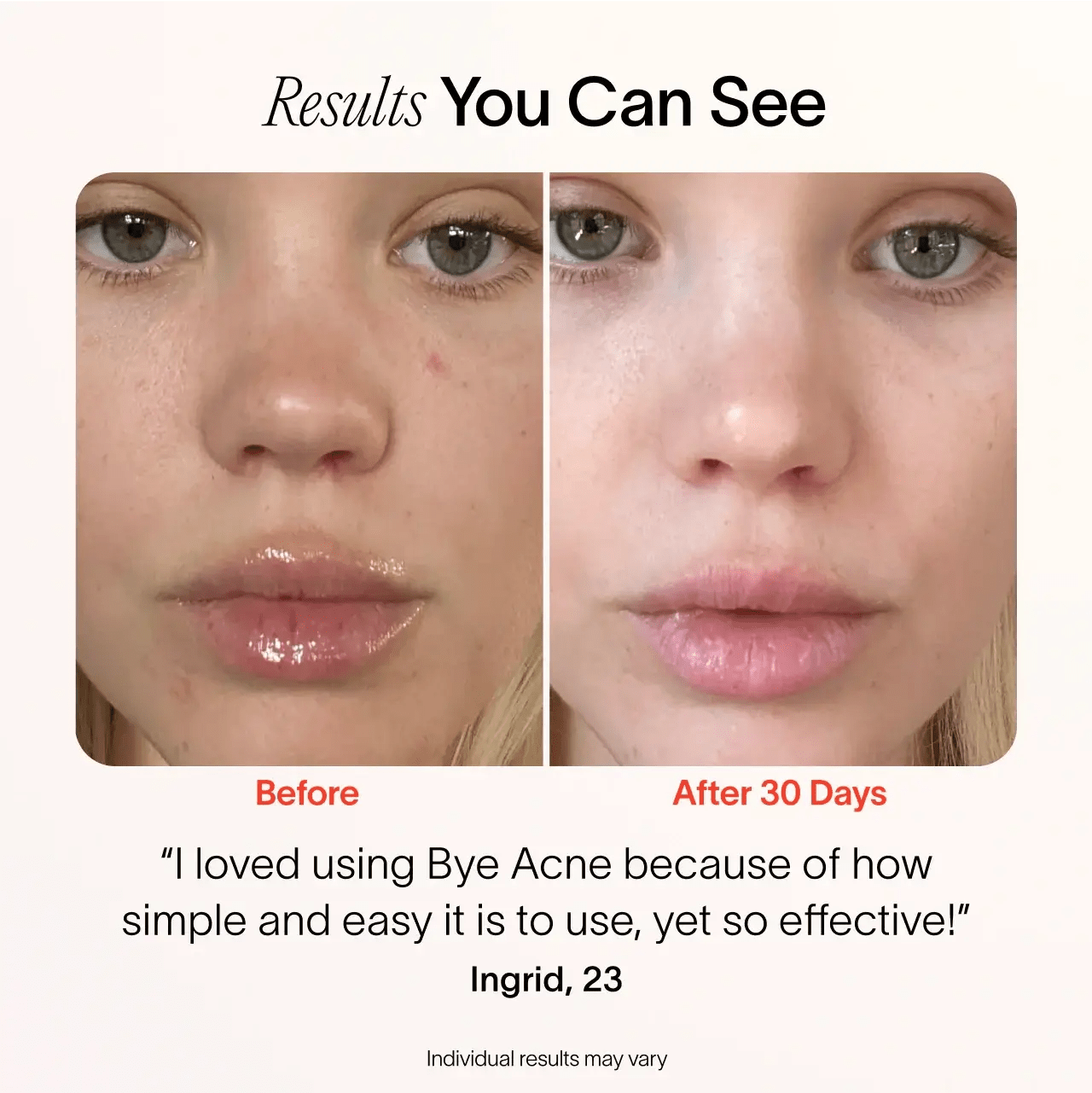 Bye Acne: 3 - Minute Pimple Spot Treatment - Mac's Got More