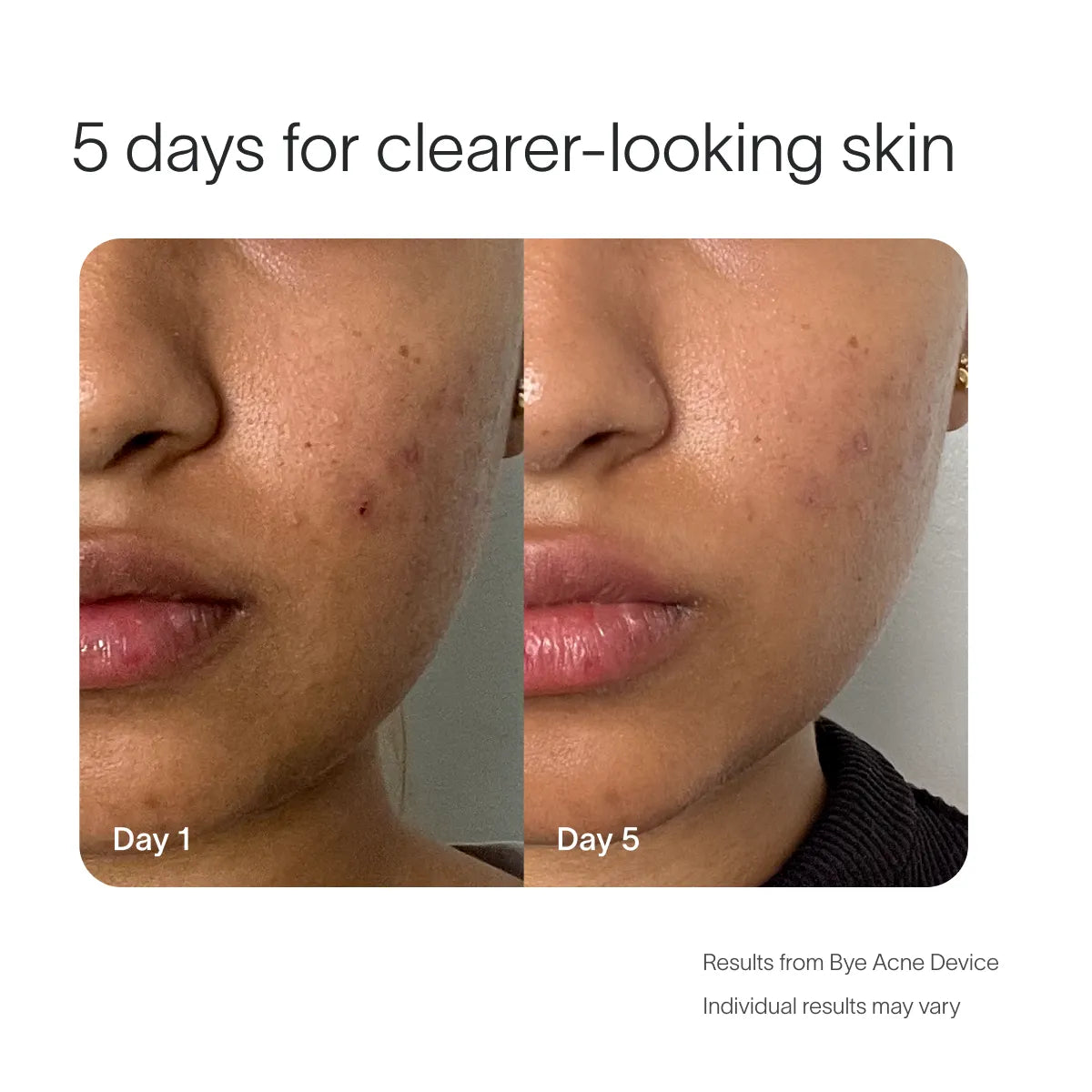 Bye Acne Pro Kit