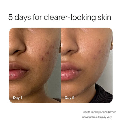 Bye Acne Pro Kit