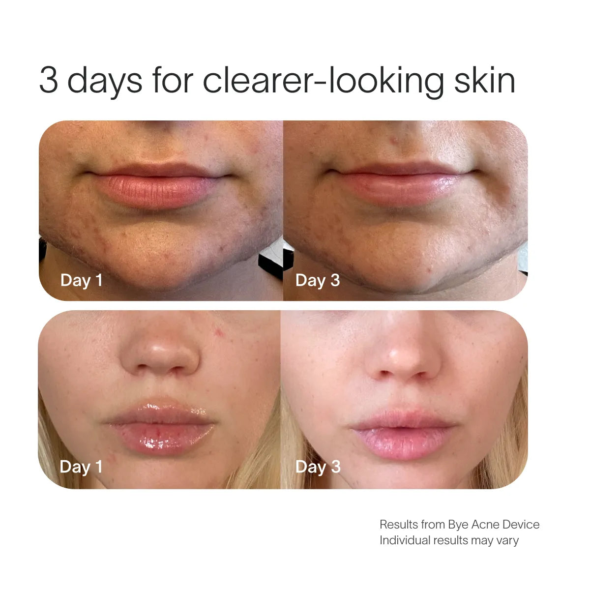 Bye Acne Pro Kit