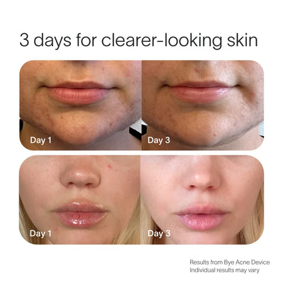 Bye Acne Pro Kit